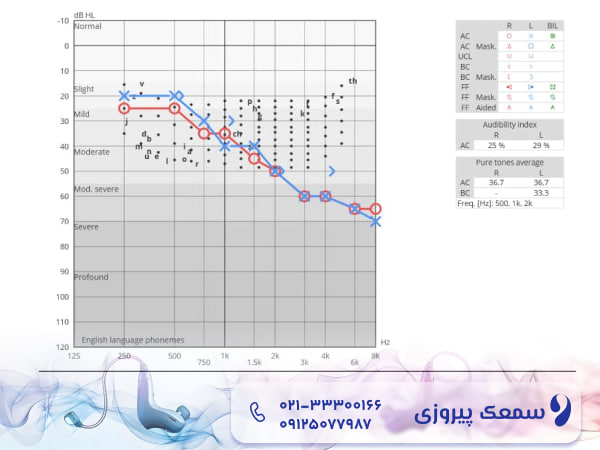 تشخیص کم شنوایی حسی عصبی